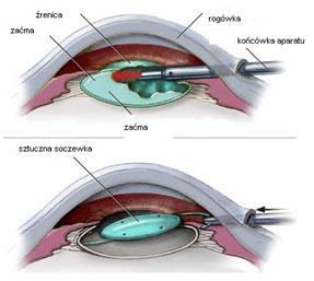 Usunięcie zaćmy połączone z wszczepieniem sztucznej soczewki do oka