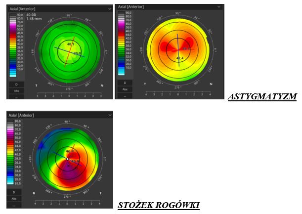 Ryc.8. Obrazy rogówki w badaniu OCT (N-Norma, A-Astygmatyzm, S-Stożek rogówki)